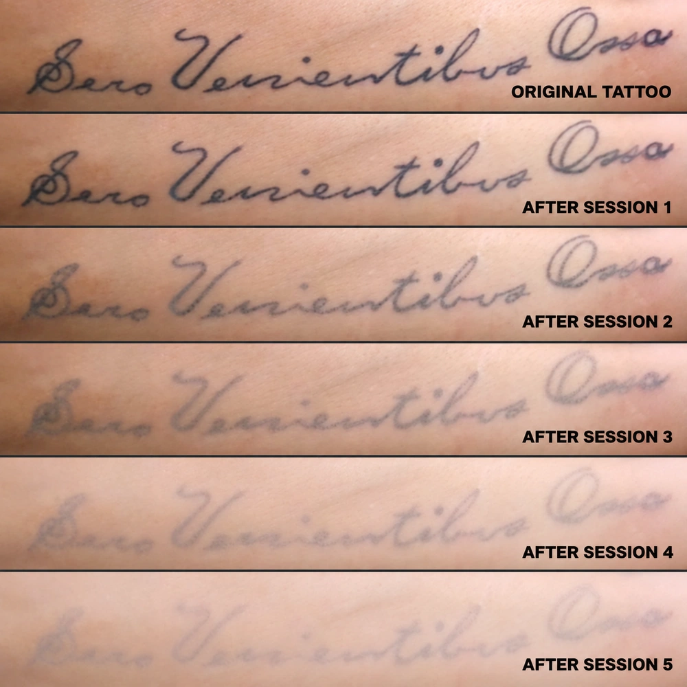 Tattoo removal progression